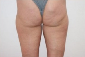 trattamento cellulite prima